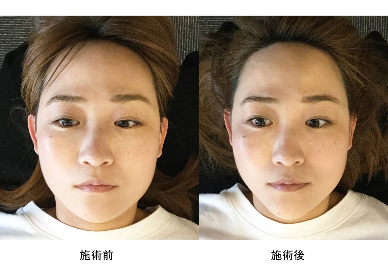顔面整体（頭蓋骨矯正）を受けた方の施術前後比較（写真版） | 萩施術 